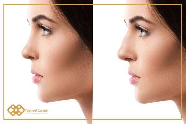 When is the result of rhinoplasty revealed?