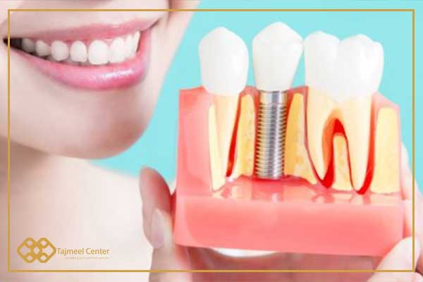 تكلفة زراعة الأسنان في تركيا: دليل شامل لعام 2024 2 تكلفة زراعة الأسنان في تركيا