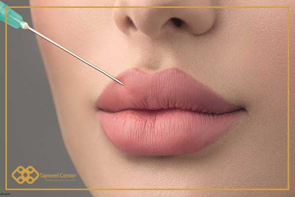 Instructions après les injections de remplissage des lèvres