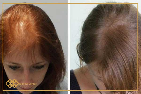 Trasplante de cabello para mujeres en Turquía