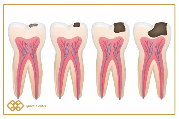 Etapas de caries dental - tratamiento de la fragilidad de los dientes