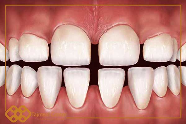 Treatment of spaces between the lower teeth