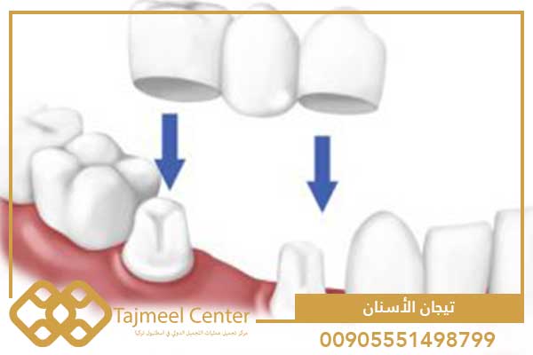 أنواع تيجان الأسنان وكيفية اختيار تيجان الاسنان المناسبة لك