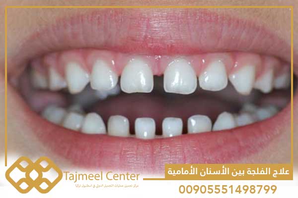 علاج الفلجة بين الأسنان الأمامية