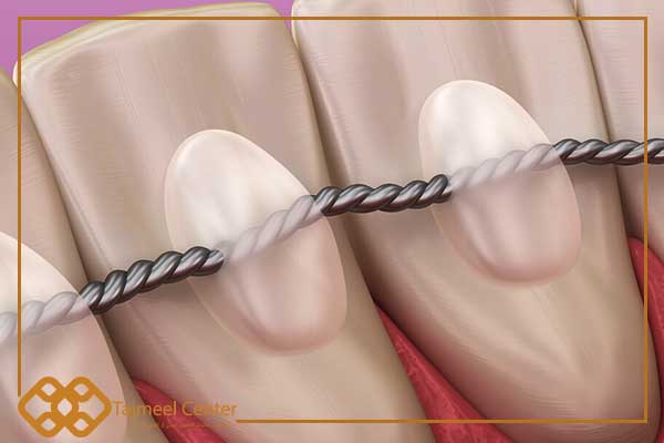 Fixation des dents après orthodontie