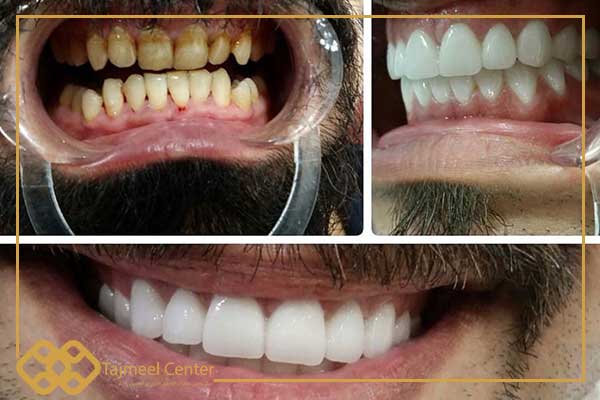 hollywood smile before and after