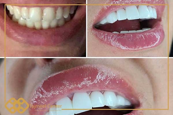 hollywood smile before and after