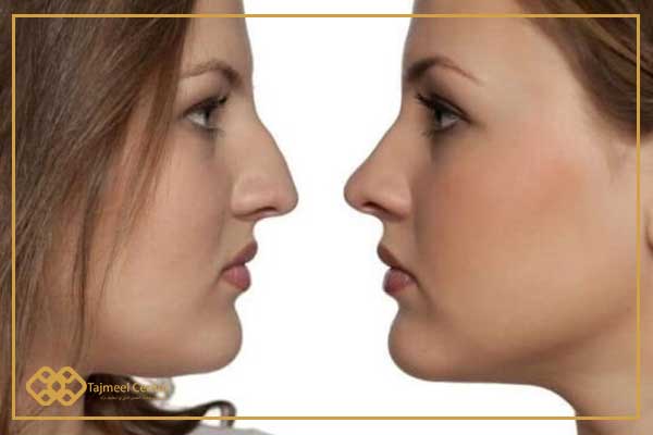 My experience with rhinoplasty - rhinoplasty before and after pictures