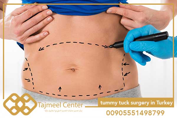 My experience with tummy tuck surgery in Turkey