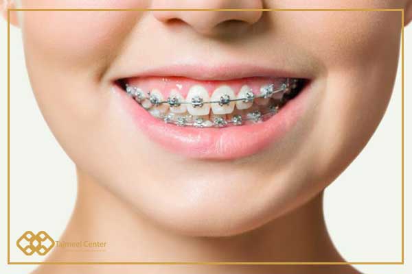 Traditional braces - types of braces with pictures and prices