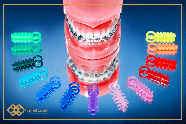 orthodontic colors - Types of orthodontics with pictures and prices