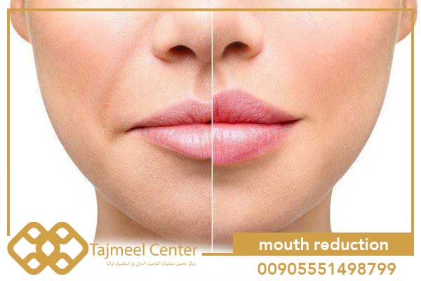 wide mouth reduction surgery