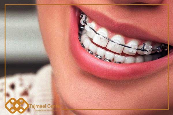Fissazione dei denti dopo l’ortodonzia