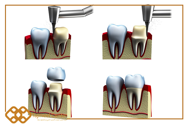 Come installare la corona dentale