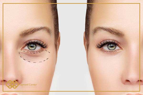 Eyelid surgery in Turkey