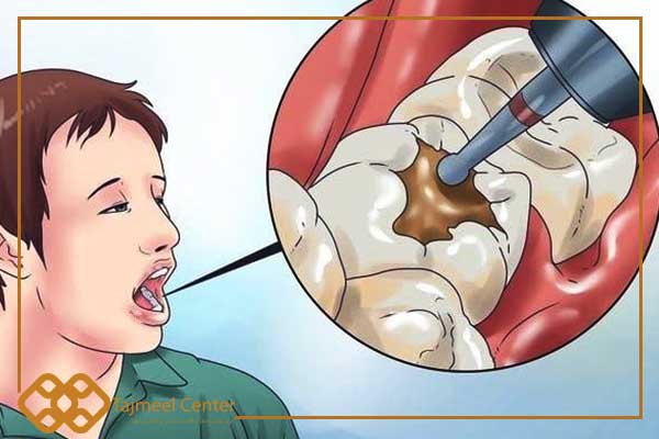 Dolore molare dopo riempimento temporaneo e stiramento del nervo