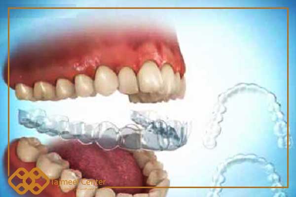 Les bagues transparentes traitent-elles les dents qui poussent ?