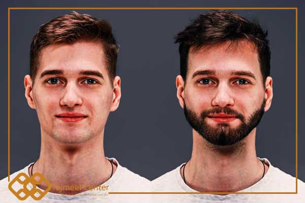 greffe de barbe avant et après