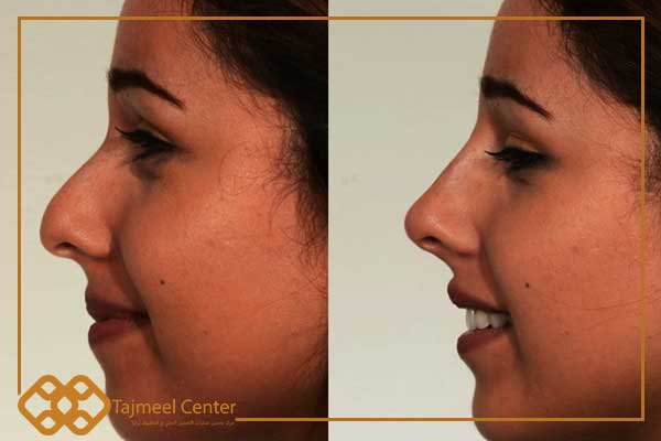 Reducción de nariz con hilos antes y después