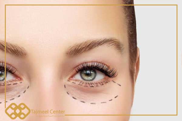 Antes de la septoplastia