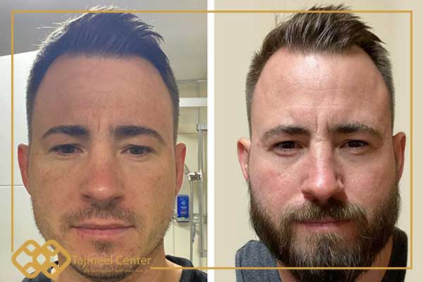 Fotos de Antes y Después