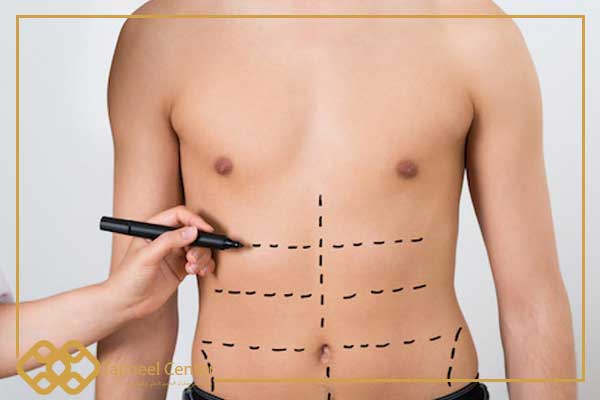 Liposucción Vaser y Miroaire de Alta Definición en Turquía: Transforma tu Cuerpo con Precisión