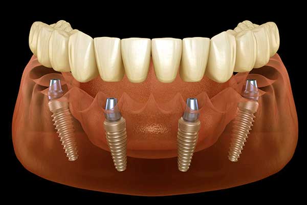 implantes dentales en turquía precios