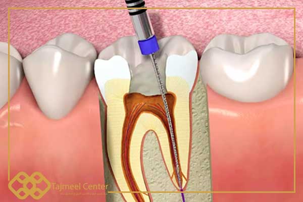 Dental nerve damage