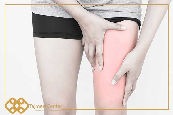 Treatment of adhesion of the thighs
