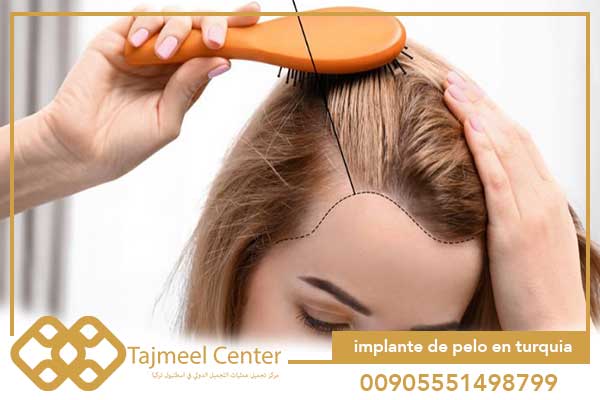implante de pelo en turquia para mujeres