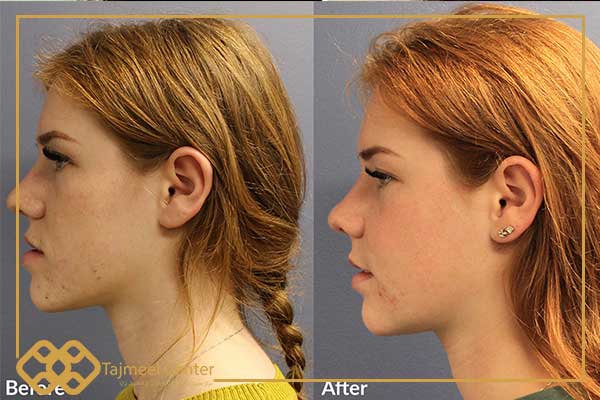 lower jaw surgery before and after