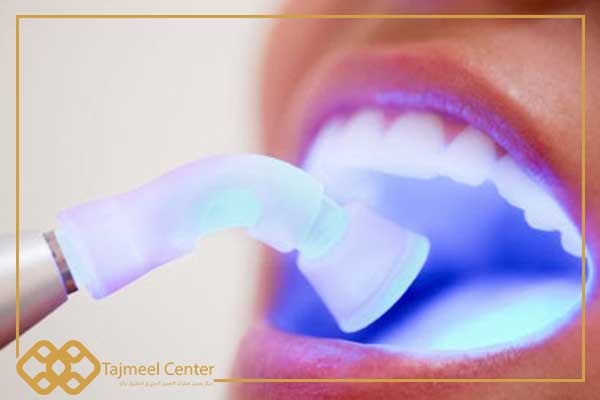 obturation dentaire en résine