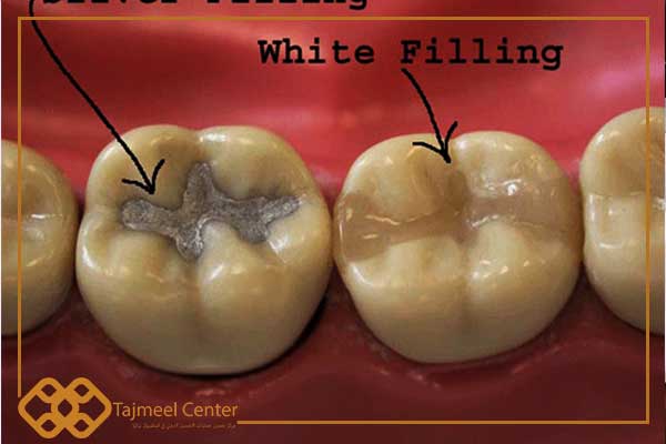 Permanent dental filling