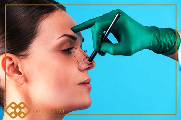 Reducing the nostrils with local anesthesia