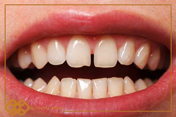 درمان فاصله بین دندان های جلو