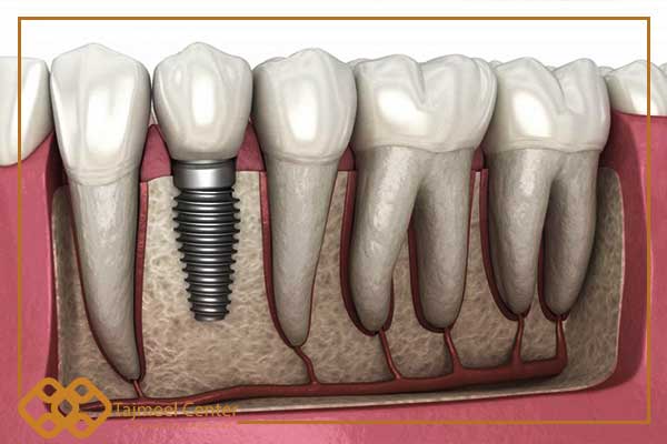 انواع ایمپلنت دندان آلمانی