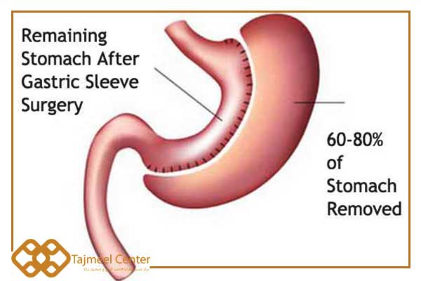 stomach reduction surgery