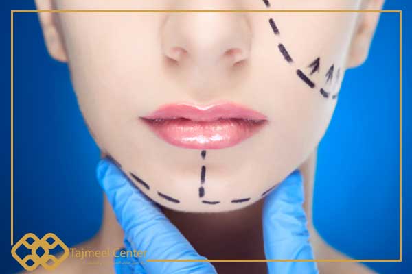 Face and neck lift surgery