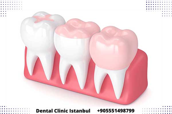 حشو الأسنان في تركيا - خيارات متنوعة و أسعار رخيصة