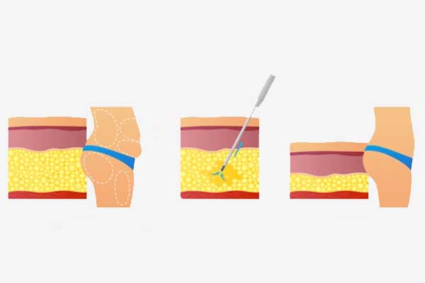 مراحل شفط دهون البطن بالتفصيل