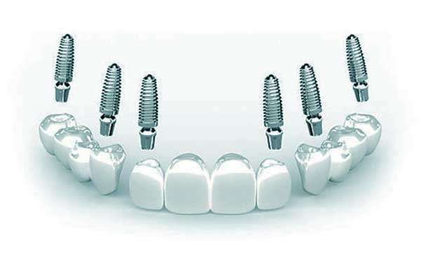 Implante dental 3 sobre 6