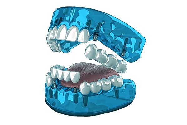 3 sobre 6 implantes dentales
