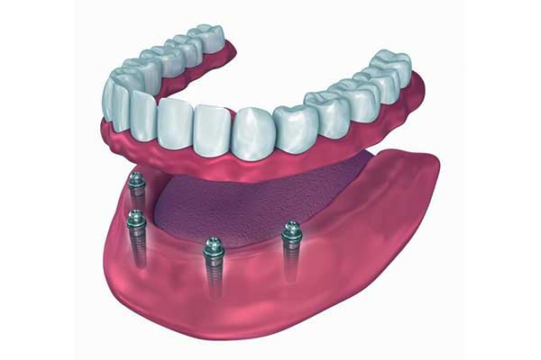 Implants dentaires tout-en-4