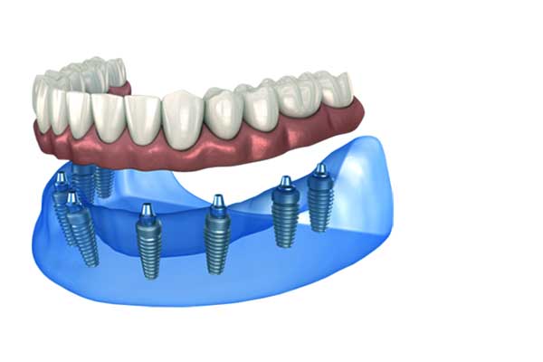 Implantes dentales All-on-6