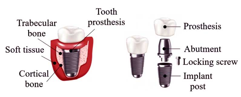 Componentes de implantes dentales