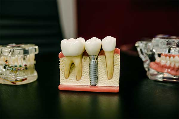 стоматолог в Турции цены