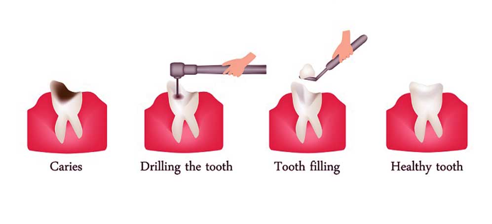 Procedura di otturazione del dente