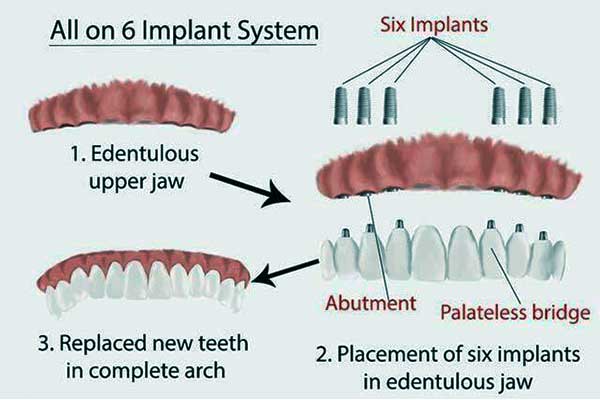 Etapas de la implantación All-on-6