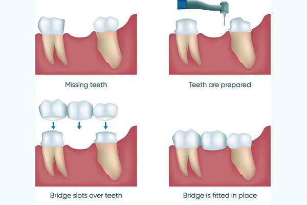 Этапы установки зубных мостов