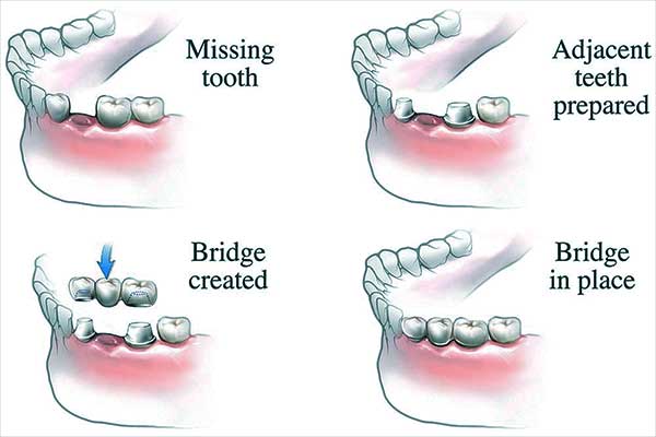 Phasen der Installation von Zahnbrücken
